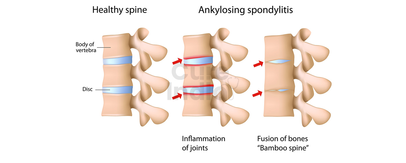 Lumbar Spinal Fusion TLIF PLIF and Lumbar Fixation